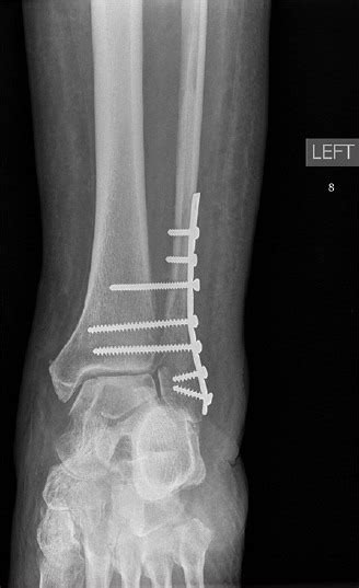 X-ray of ankle joint anteroposterior view showing multiple syndesmotic... | Download Scientific ...