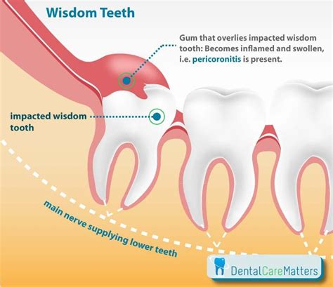 Periocoronitis- infection of the gum flap over partially erupted teeth ...