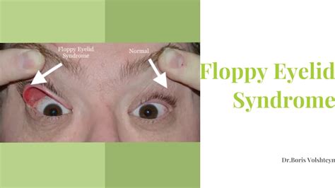 Floppy Eyelid Syndrome - Treatment Options - Dr. Boris Volshteyn - YouTube