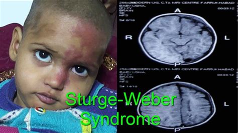 Sturge-Weber syndrome