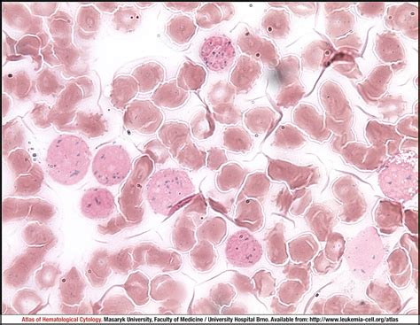 Acute monoblastic/monocytic leukaemia - CELL - Atlas of Haematological Cytology