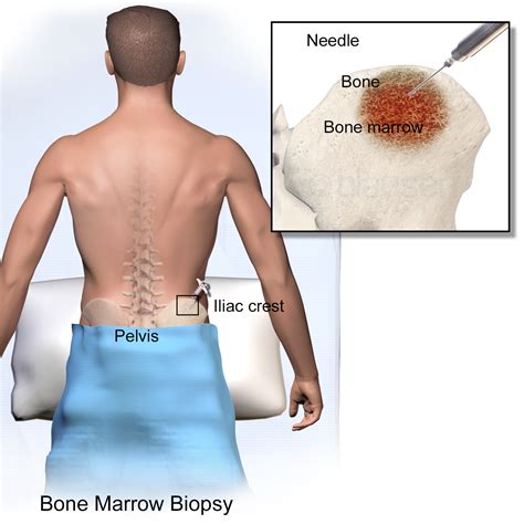 Bone Marrow Aspiration & Biopsy