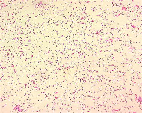 Brucellosis Treatment: Rifampicin vs Streptomycin - Infectious Disease Advisor