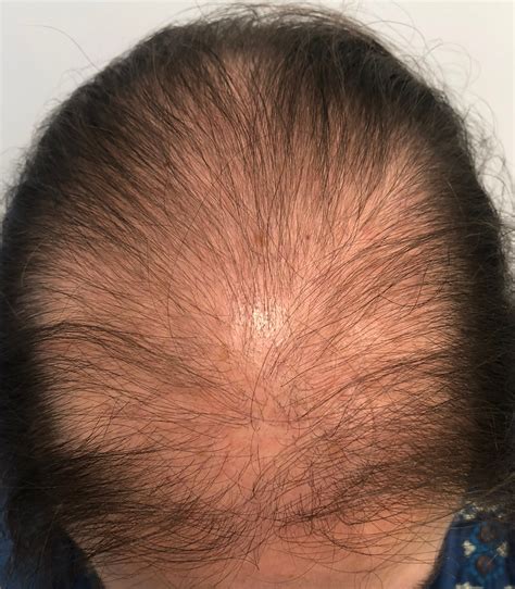 Alopecia Androgénica Femenina Premenopausica - Mujeres, Pérdida de pelo ...