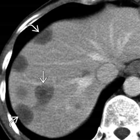 Epithelioid Hemangioendothelioma | Radiology Key