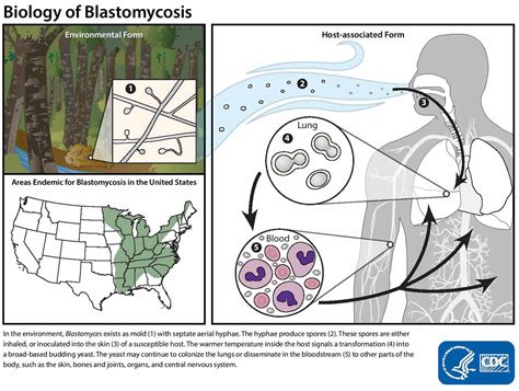 Blastomycosis in humans causes, symptoms, diagnosis and treatment