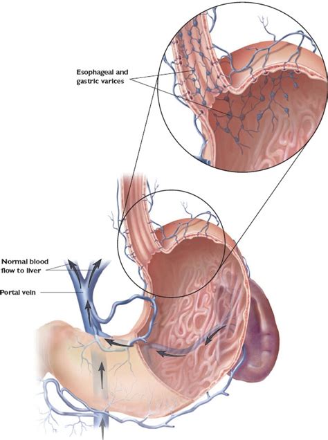 Emergency—Bleeding Esophageal Varices: What Nurses Need to Know - Off the Charts