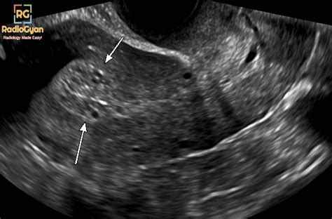 Tamoxifen-associated Endometrial Changes Ultrasound - RadioGyan