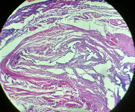 Globulomaxillary Cyst Histology