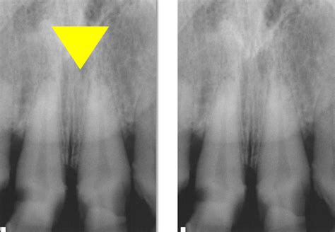 Anatomy on Radiographs: Intraoral Radiographs Part I – Dr. G's Toothpix