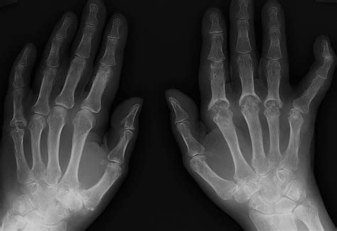 Psoriatic arthritis – hands - Radiology at St. Vincent's University Hospital