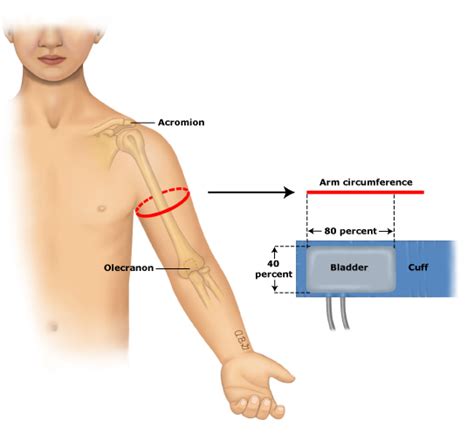 How to select correct cuff size for measuring blood pressure ...