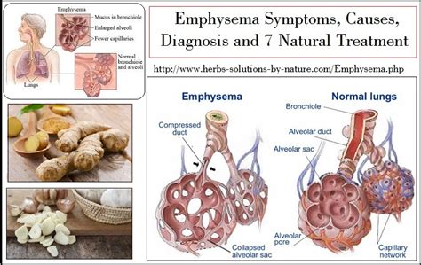 Exclusive Information about Emphysema Symptoms, Causes Diagnosis and ...