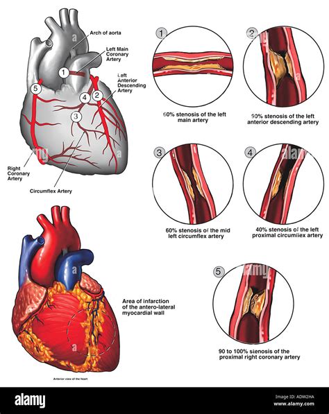 Atherosclerotic Coronary Artery Disease Stock Photo - Alamy