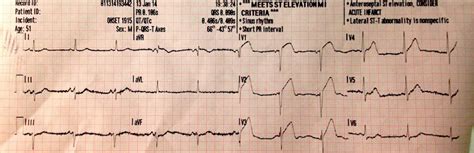 Wellens Syndrome • LITFL • ECG Library Eponym