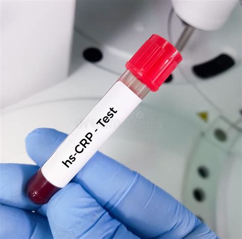 Blood Sample for Hs-CRP (high Sensitivity - CRP) Test, for the Diagnosis of Inflammatory Heart ...