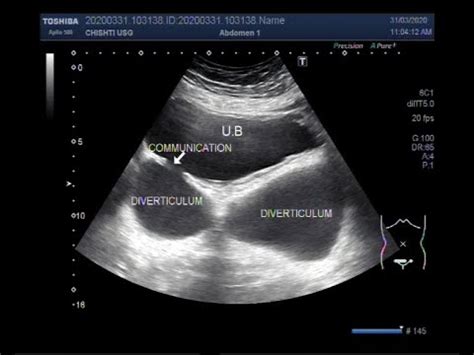 Diverticulum Of Bladder Ultrasound