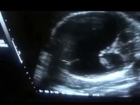 ultrasound HOLOPROSENCEPHALY part 3 of 3 - YouTube