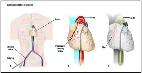 Cardiac Catheterization - procedure, recovery, test, blood, tube, pain, complications, time