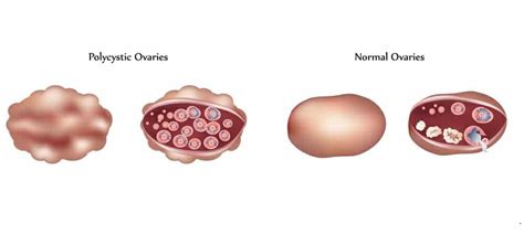 The Truth About PCOS and Ovarian Cysts