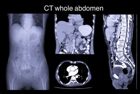 Epiploic Appendagitis Symptoms, Causes, and Prognosis - Health & Detox ...