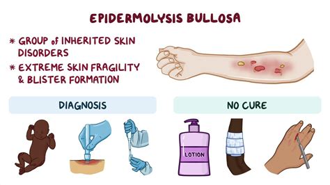 Epidermolysis bullosa: Year of the Zebra: Video | Osmosis