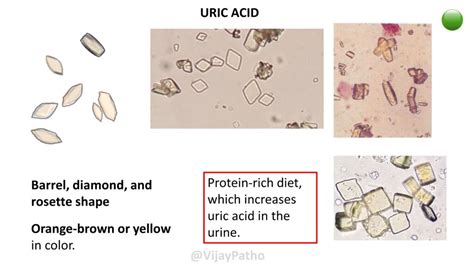 URINARY CRYSTALS - Pathology Made Simple