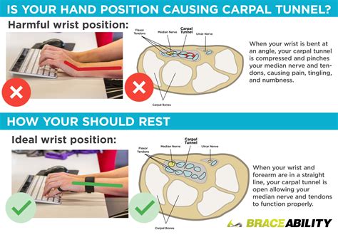 Carpal Tunnel Syndrome Causes