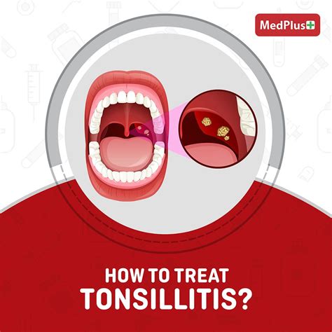 What is Tonsillitis? Symptoms & Treatment : r/healthylifestyle007