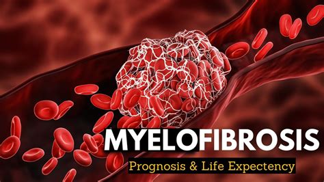 Myelofibrosis Explained: What You Need to Know - YouTube