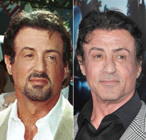 Sylvester Stallone Plastic Surgery Before and After | Plastic surgery ...