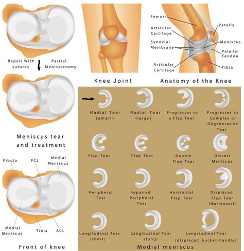 What Is A Medial Meniscus Tear? — Dr. Bill Sterett