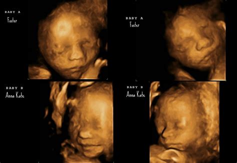 At Last...Twins: 26 Weeks & 4D Ultrasounds