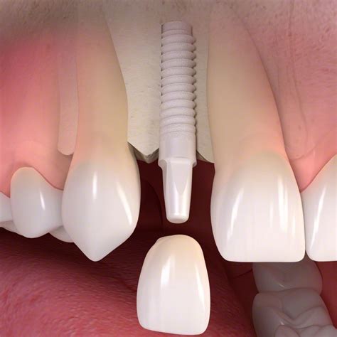 Zirconia Implants Melbourne | Laser + Holistic Dental | Learn More