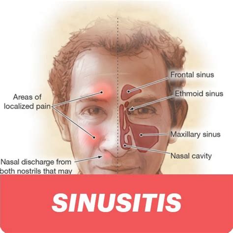 Sinusitis- types, causes, symptoms complications | Sinus headache, Sinus pain, Sinusitis