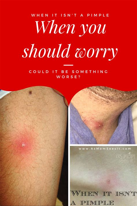 When A Pimple Is Something Worse: Could It Be MRSA? | Fungal infection skin, Spider bite ...