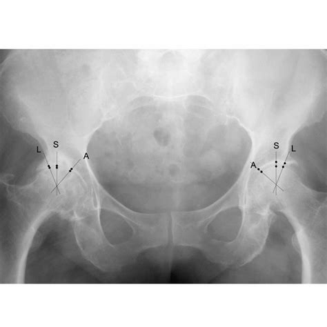 Supine AP X-ray of the right hip joint with a non-displaced subcapital ...