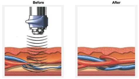 Shockwave vs Acoustic Wave Therapy for ED: 1 Big Difference