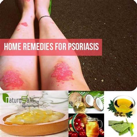 Psoriasis Home Remedies - My Daily Magazine - Art, Design, DIY, Fashion and Beauty