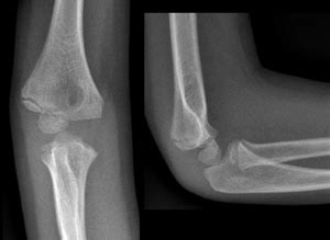 Clinical Practice Guidelines : Lateral condyle fracture of the humerus ...