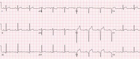 early repolarization or anterior STEMI | ECG cases | EM cases