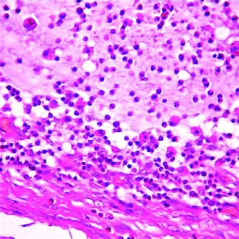 (PDF) Mucocele of the dorsal surface of the tongue: A case report