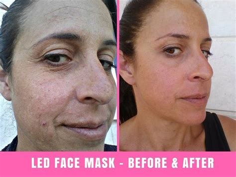 Project E Beauty LED Face Mask Before and After (30 Days) | Led face ...