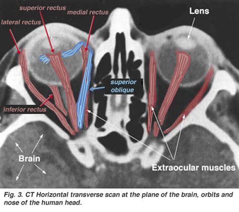 CT Scan Tips & Protocols: Rectus muscles in Orbit CT