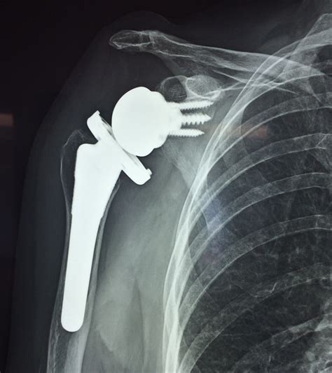 Shoulder Surgery and Replacement