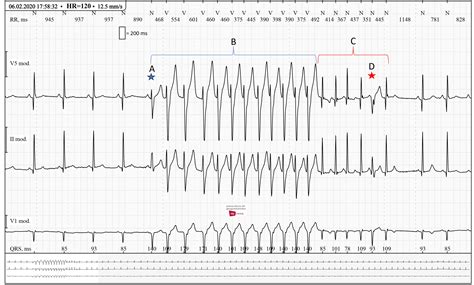 Ventricular Tachycardia Vs Supraventricular Tachycardia