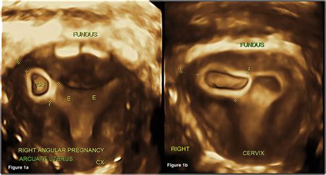 Angular Pregnancy in an Arcuate Uterus: Hysteroscopic Management of Retained Products of ...