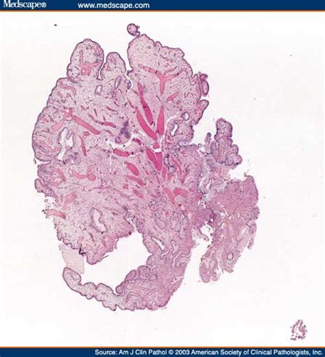 Pathology Outlines - Endocervical polyp