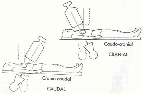 Pedi cardiology: Cath: Caudo-cranial vs. Cranio-caudal projection