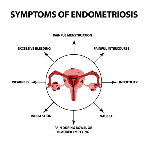 How to treat endometriosis